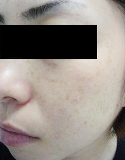あさぶ皮フ科クリニックは札幌市の麻生にある皮膚科・美容皮膚科・皮膚外科・小児皮膚科です。Webからの予約が可能です。どんな些細なことでも皮膚症状でお悩みならお気軽にご相談ください。