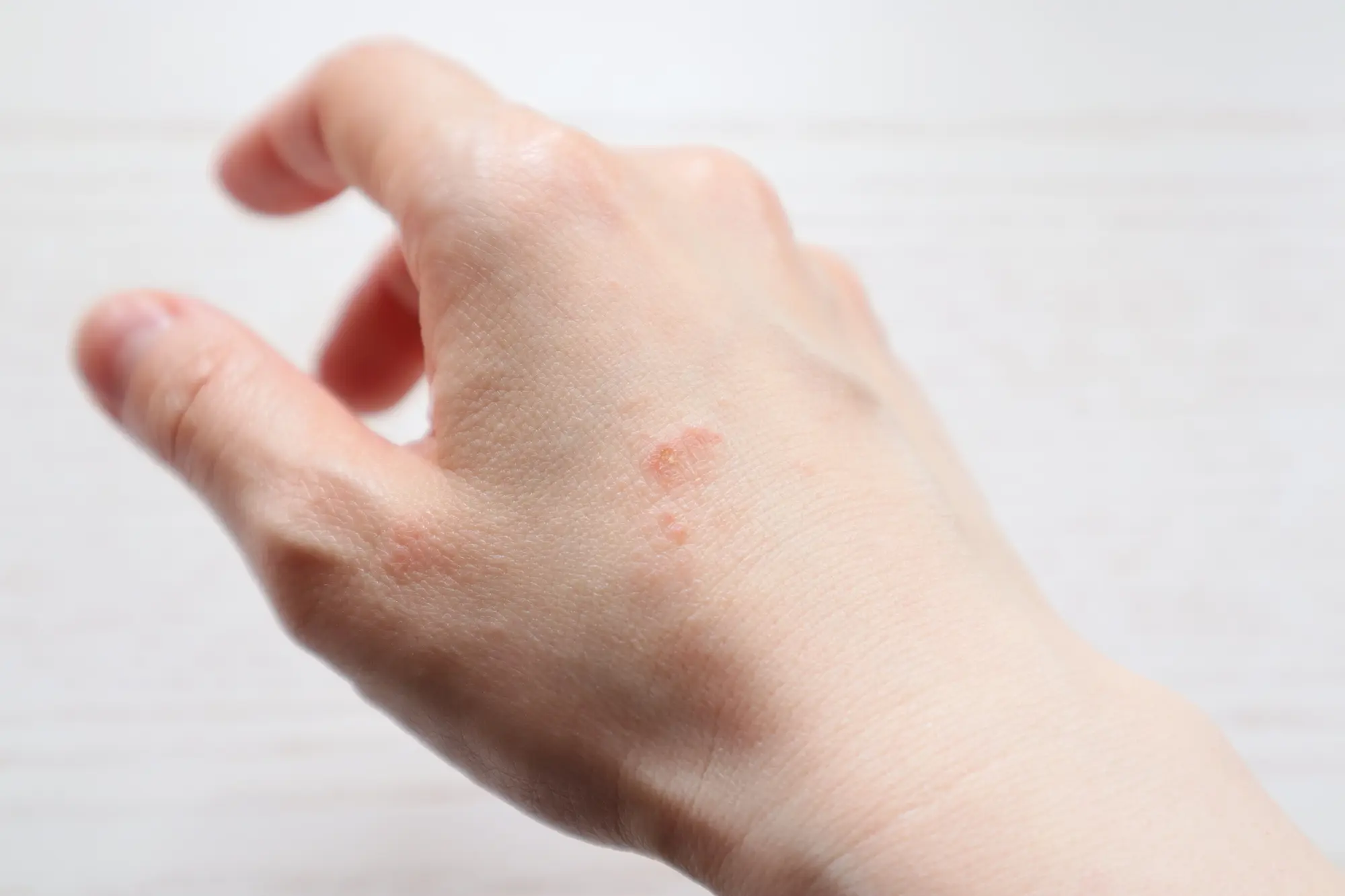 あさぶ皮フ科クリニックは札幌市の麻生にある皮膚科・美容皮膚科・皮膚外科・小児皮膚科です。Webからの予約が可能です。どんな些細なことでも皮膚症状でお悩みならお気軽にご相談ください。